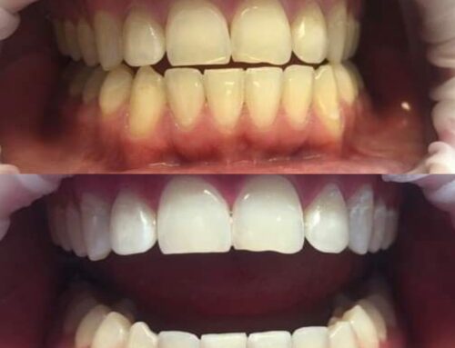 Uus hammaste valgendussüsteem – BlancOne