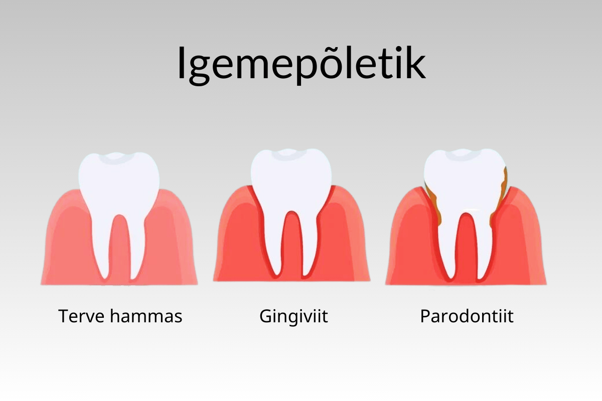 Igemepõletik