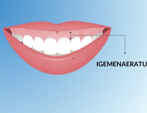 Igemenaeratust ehk “Gummy Smile’i” on võimalik ravida