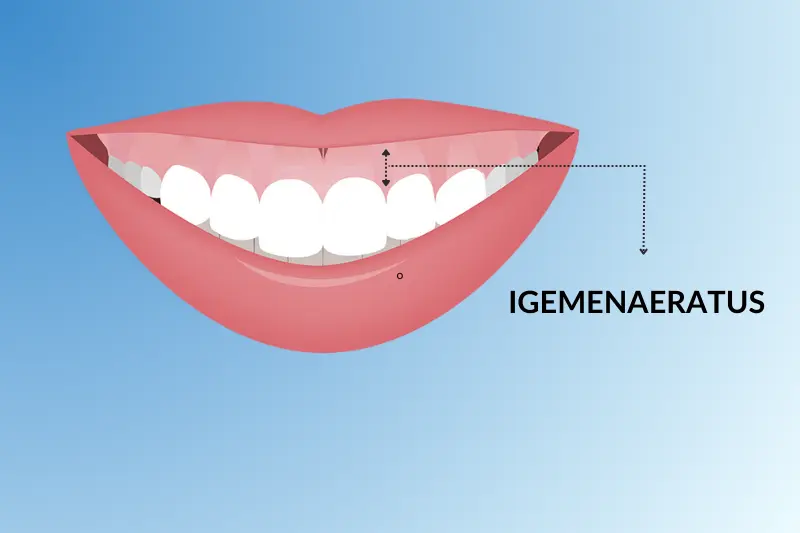 Igemenaeratus ehk “gummy smile” on pigem esteetiline mure, mis ei ole üldjuhul seotud suu tervisliku olukorraga. Küll aga võib see põhjustada ebameeldivustunnet