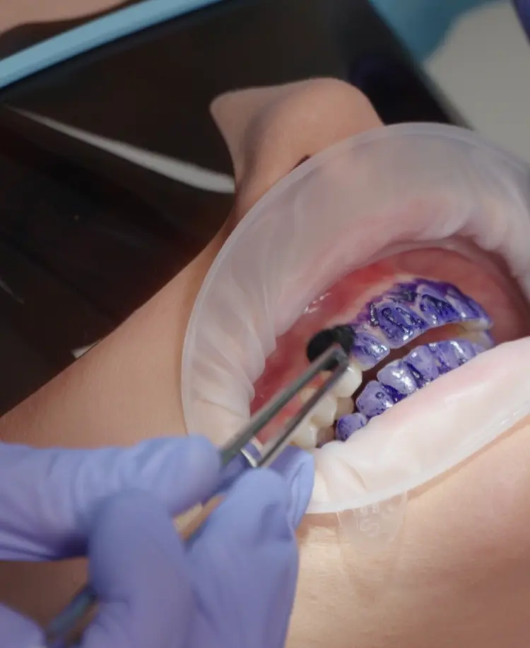 GBT hammaste puhastamine