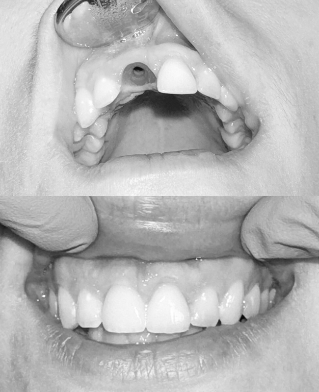 Kohene implantatsioon before and after